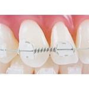 Ortho Technology Wire Products / Tooth Tone Coated Archwire And Accessories